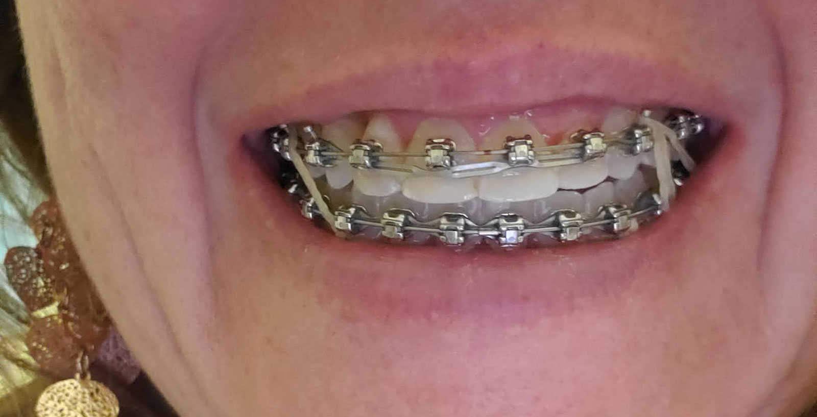 Adult braces? Here's five easy tips to making them less miserable My